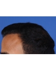 After Hair Transplant&nbsp;Front